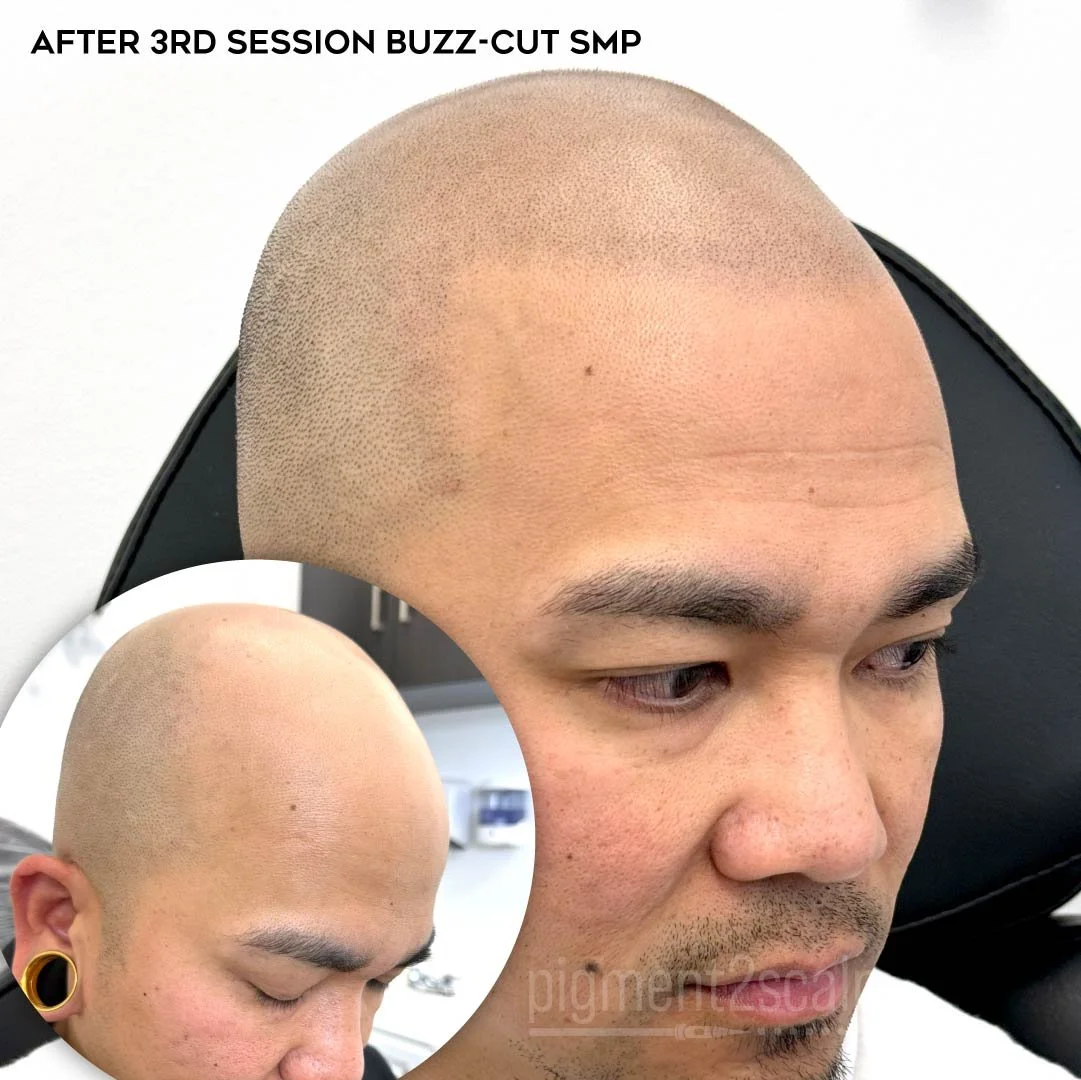 smp-san-diego-scalp-micropigmentation-healed-72dp-01_hair-loss.jpg