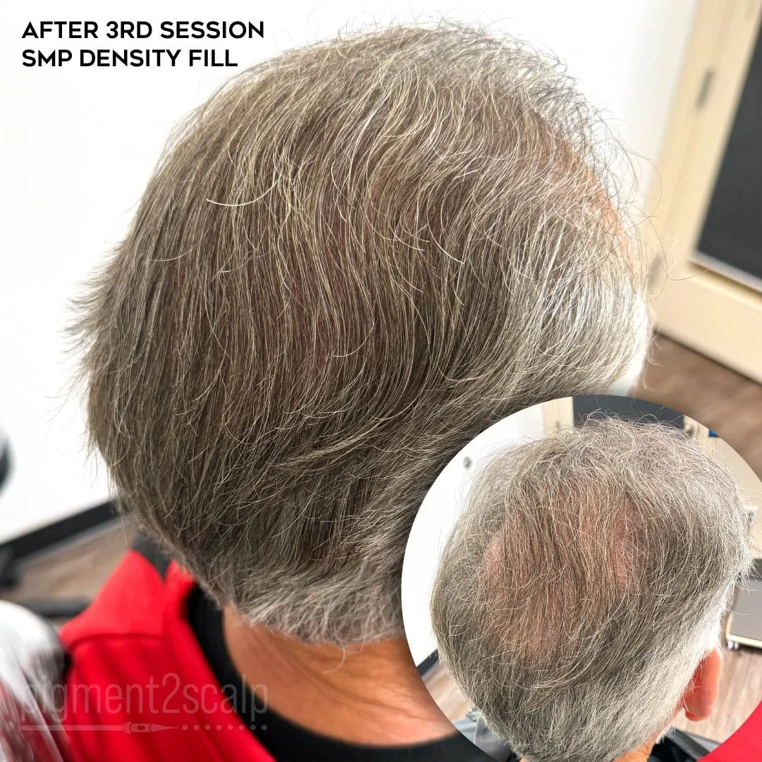 smp-san-diego-scalp-micropigmentation-healed-72dp-10_density-thicker-hair.jpg