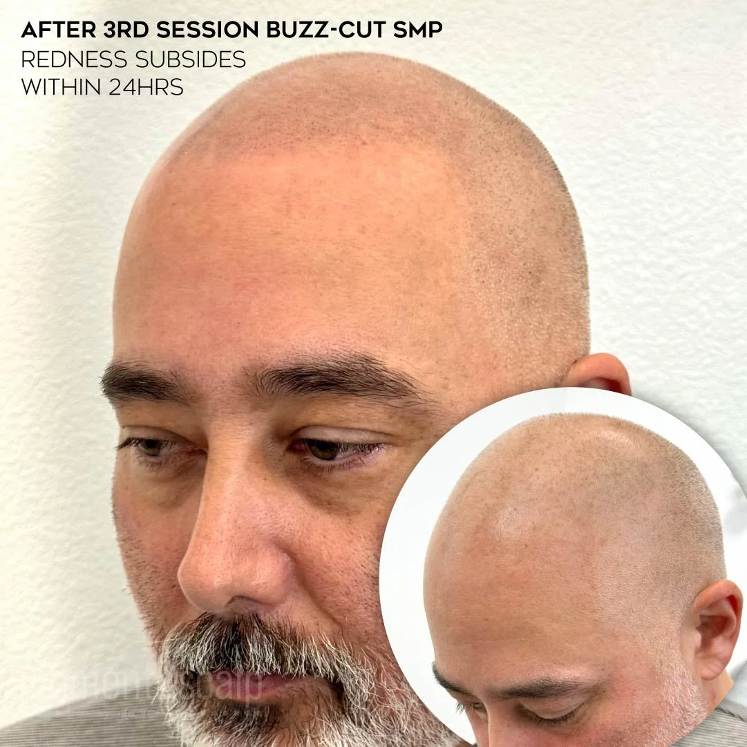 smp-san-diego-scalp-micropigmentation-healed-72dp-11_SMP-white-hair.jpg