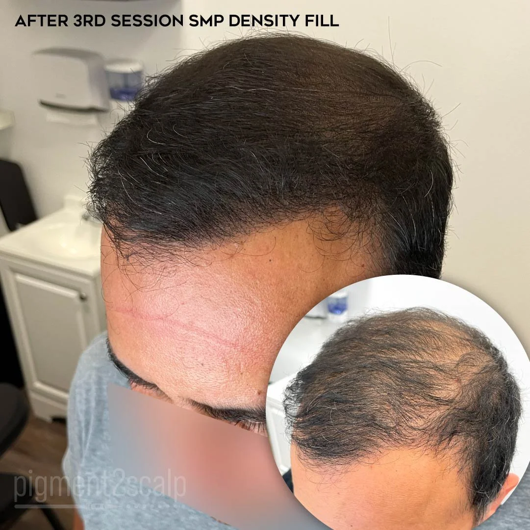 smp-san-diego-scalp-micropigmentation-healed-72dp-03_Thinning-Hair.jpg