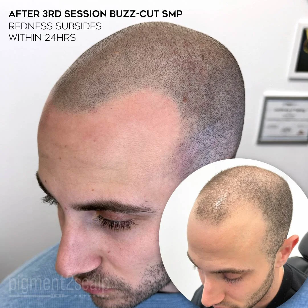 smp-san-diego-scalp-micropigmentation-healed-72dp-16_mature-hairline.jpg