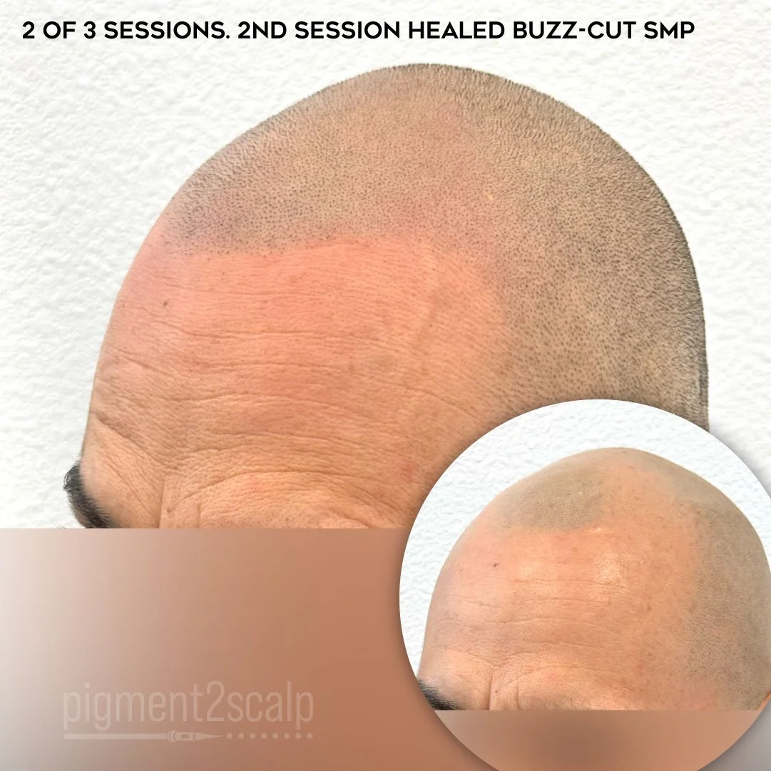 fix patchy hair loss scalp micropigmentation solution