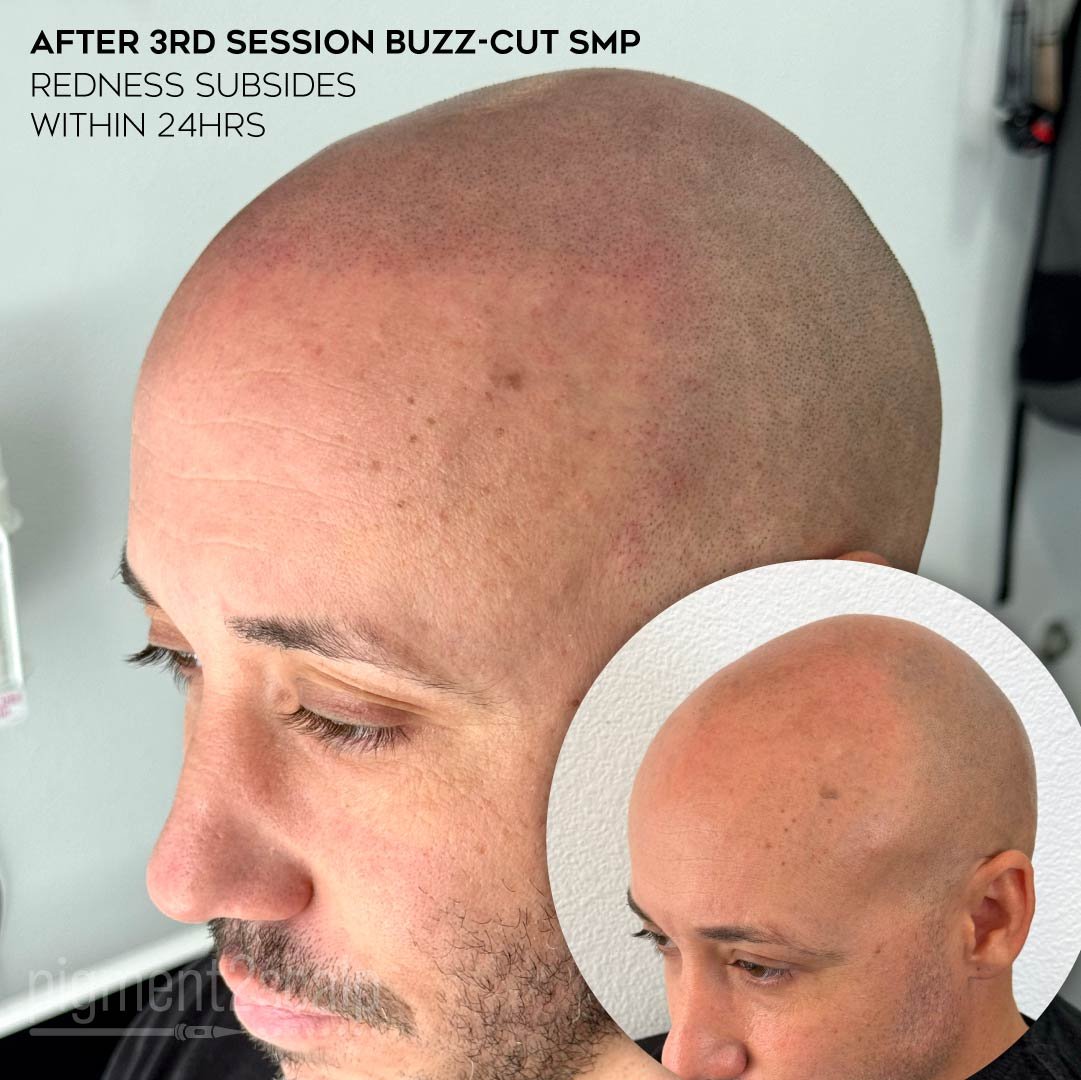smp-san-diego-scalp-micropigmentation-healed-72dp-04_Bald-Man.jpg