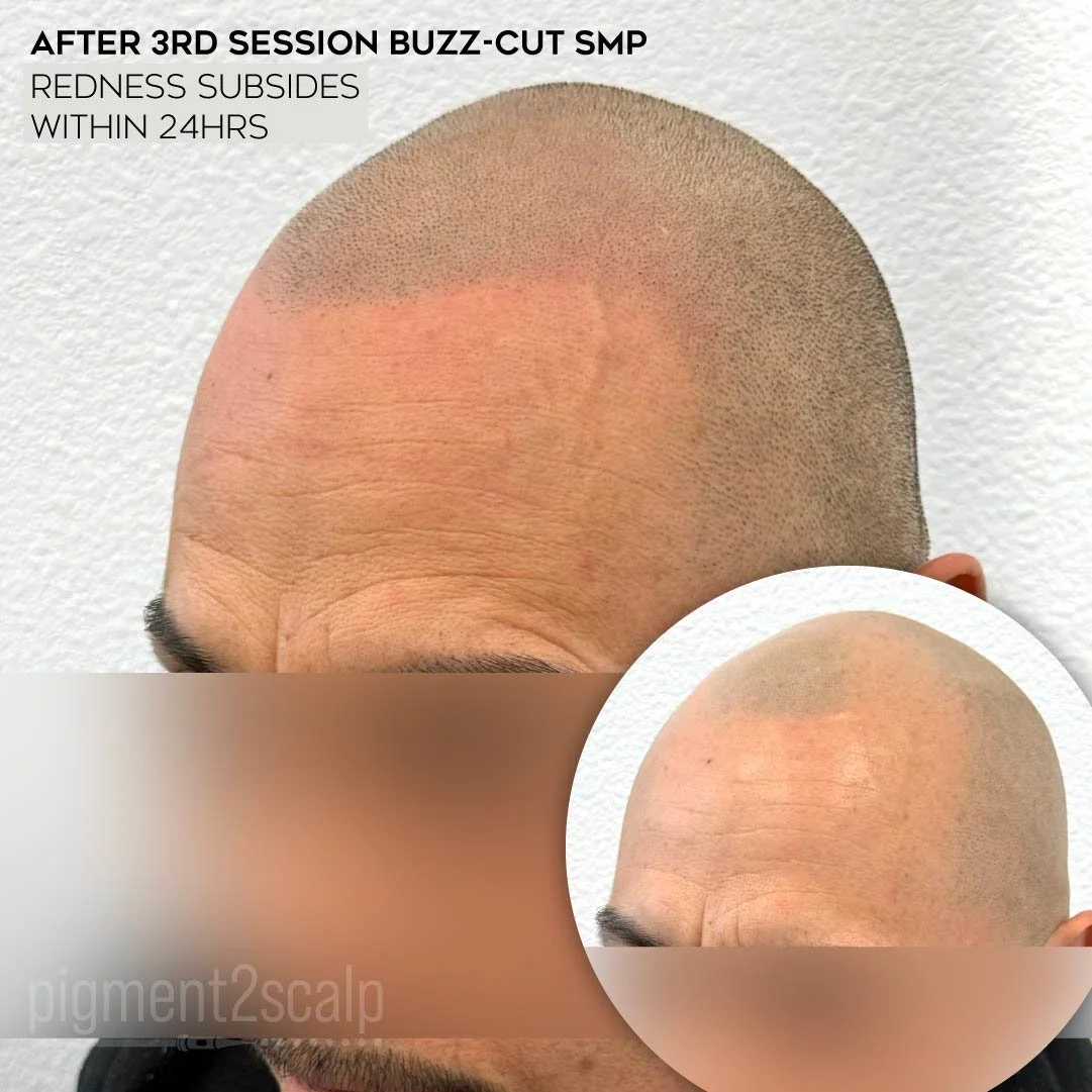 smp-san-diego-scalp-micropigmentation-healed-72dp-15_natural-look-smp.jpg