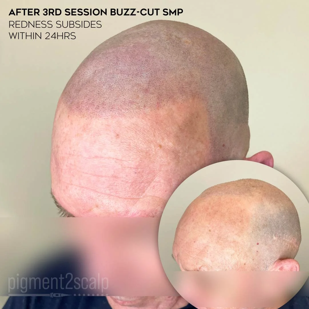 smp-san-diego-scalp-micropigmentation-healed-72dp-12_natural-look-smp.jpg