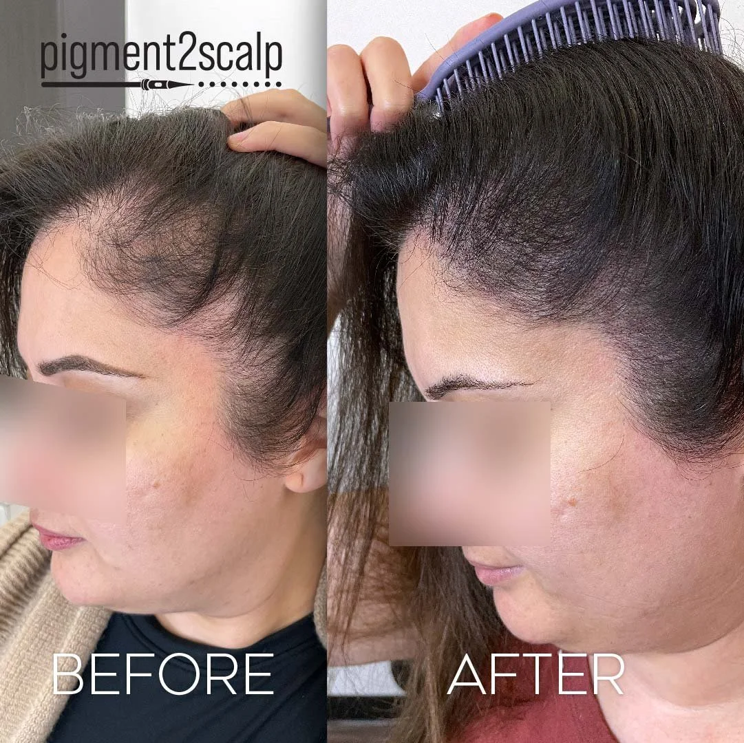 For men and women experiencing hair loss. This cosmetic hair tattoo service is a long lasting solution to conceal areas of thinning and pattern balding.