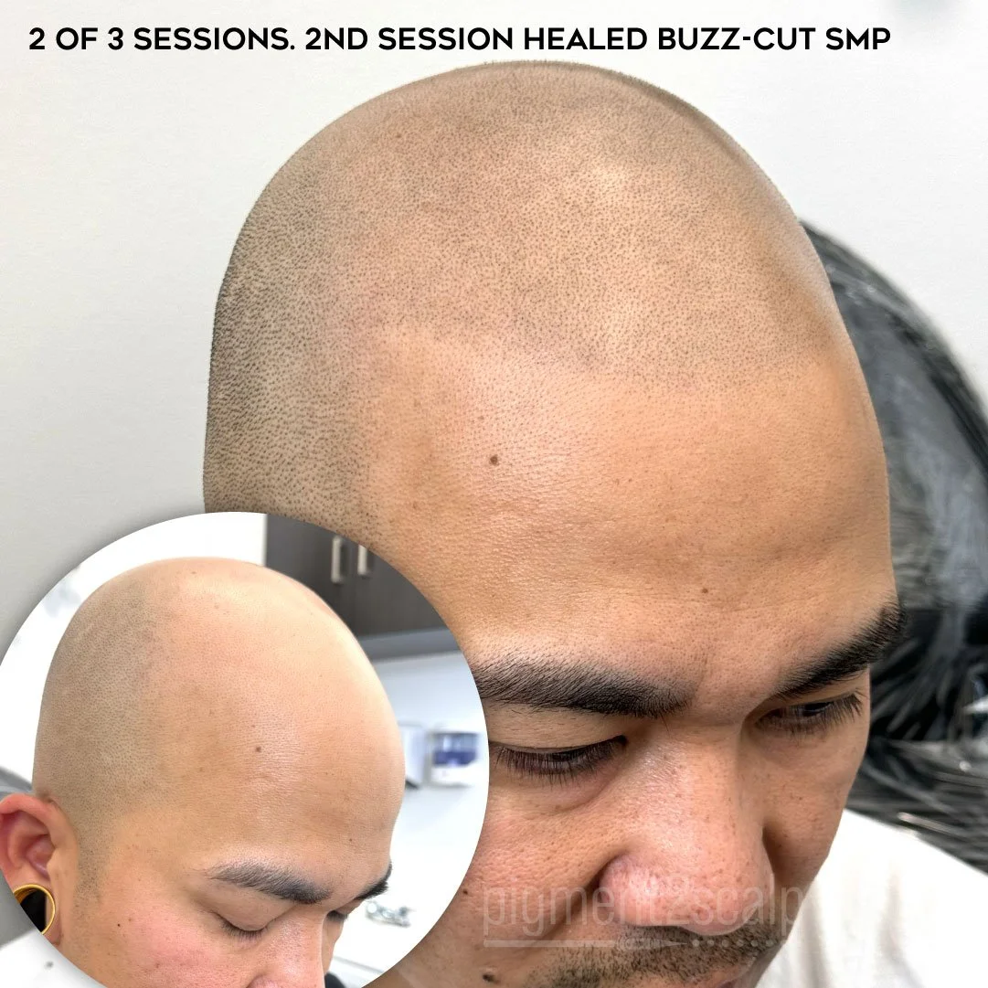 bald man before after scalp micropigmentation hair loss solution