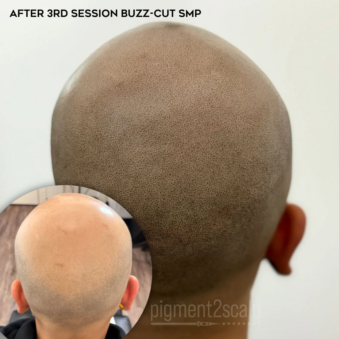 cul-del-sac hairloss fix scalp micropigmentation hair tattoo san diego