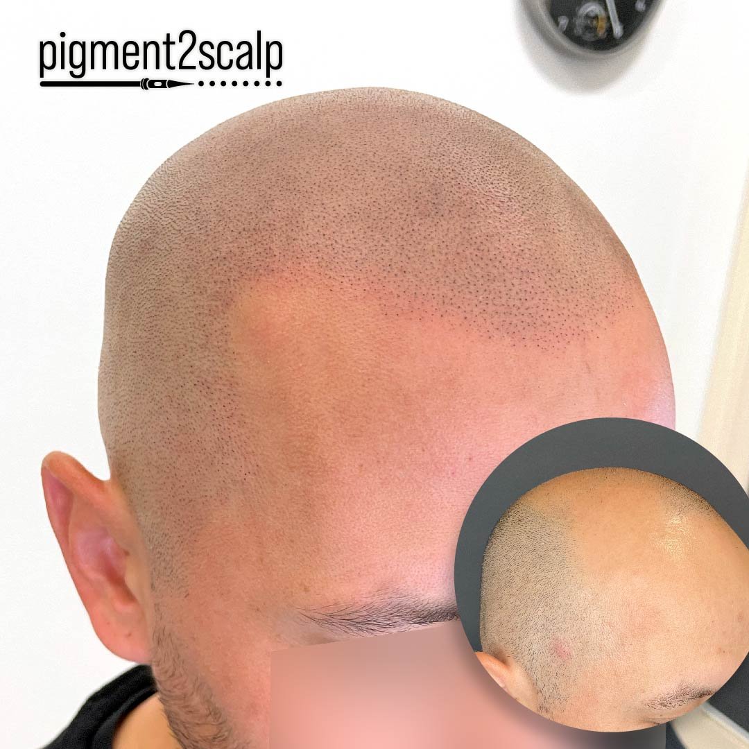 Allow us to craft the natural hairline and enhanced density you've been seeking.