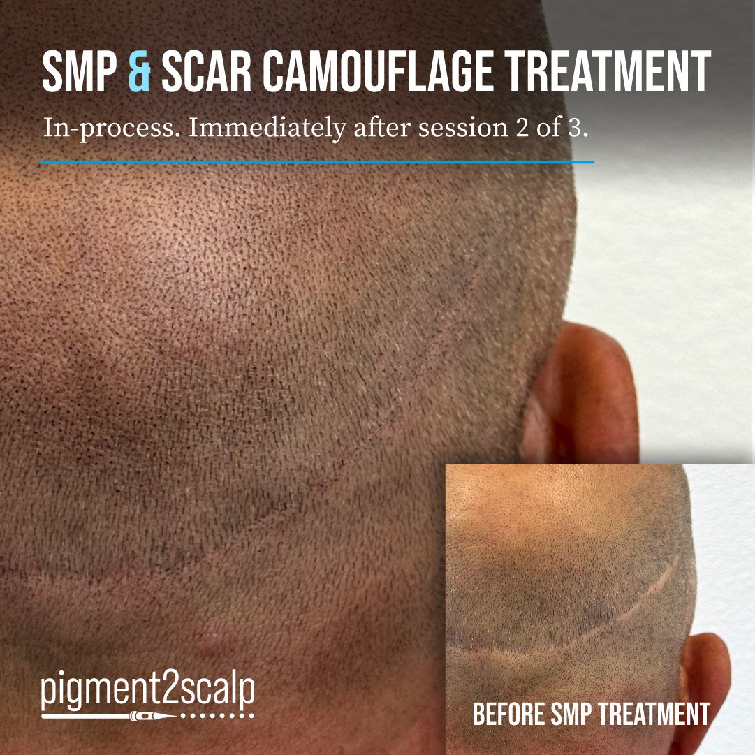 san diego hair transplat scar camouflage concealment