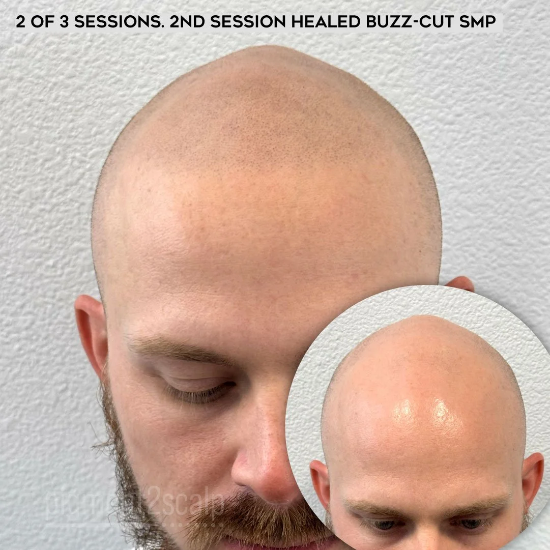 natural looking scalp micropigmentation smp san diego best