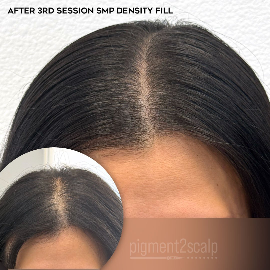 Before and after of scalp shading with scalp micropigmentation smp density fill to reduce womens female part line