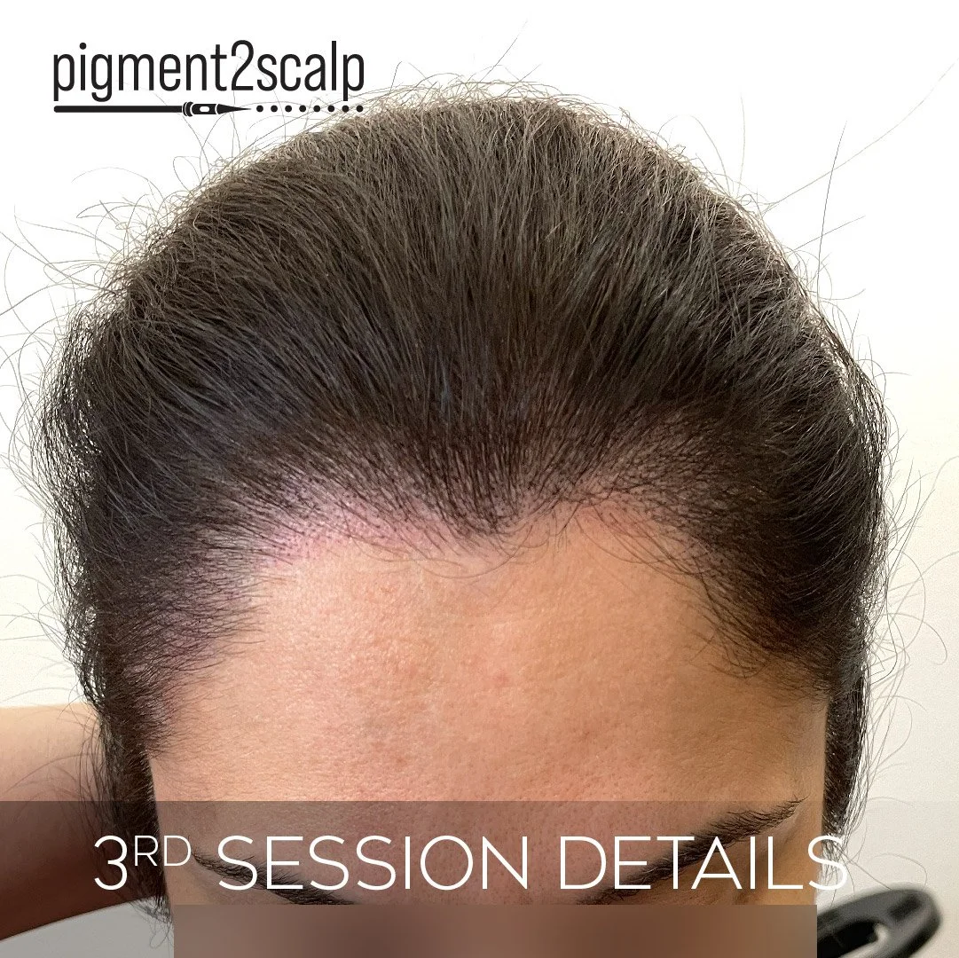 san-diego-thinning-hair-density-smp-front-results-C-03.jpg