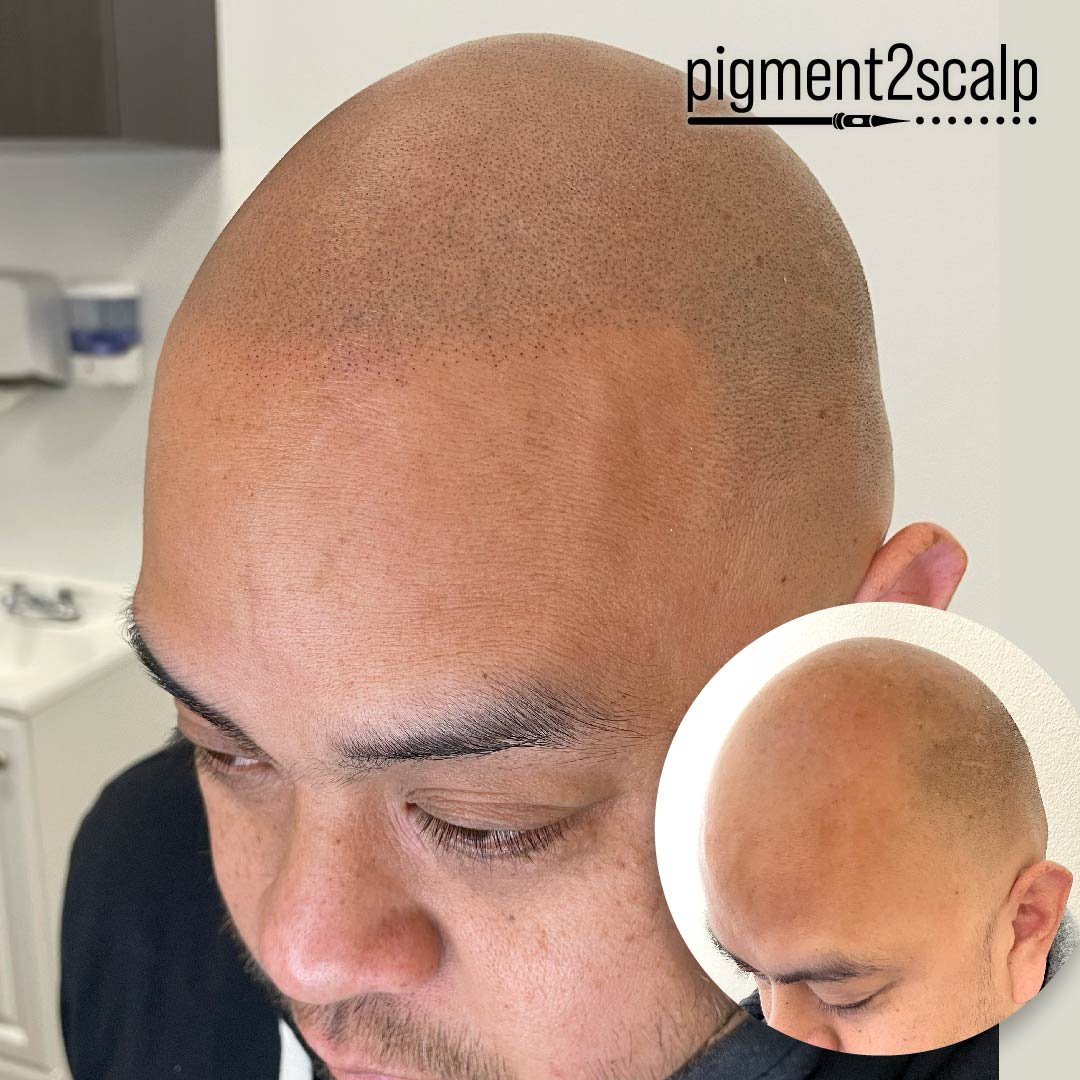 Revive your look by restoring your hairline.
