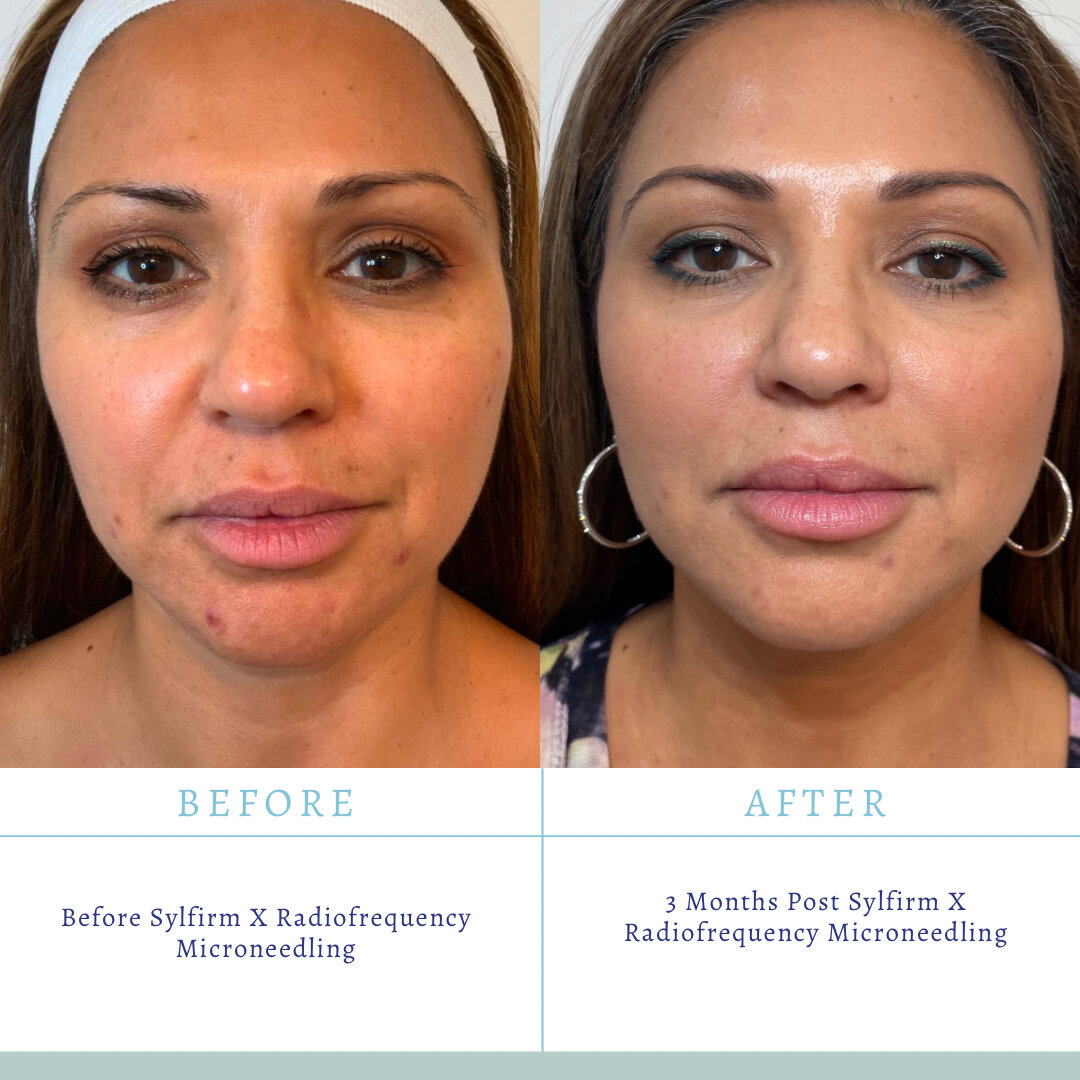 Before and after 3 months of Sylfirm X Radio-frequency Microneedling😍🥰🔥 ​​​​​​​​
​​​​​​​​
Treatments: ⤸​​​​​​​​
Hormone Pelleting, Stress Incontinence, Bladder Control, Dermal Fillers + Wrinkle Treatment, Micro-needling, Laser Facial Rejuvenation,