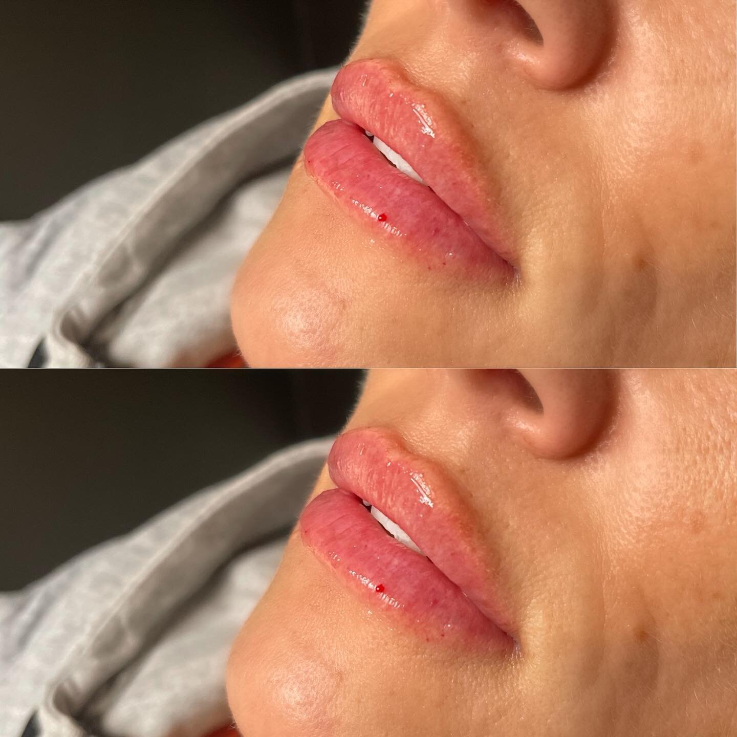 Eeek how gorgeous is she 😍

Summer ready! The sweetest, making my job easy peezy. Mini Lip Augmentation. These were built slowly over time.

#lipfiller #lips #plump #thesweetest #plumplios #dermalfillers #lipfillerbeforeandafter #barrielips #barrien