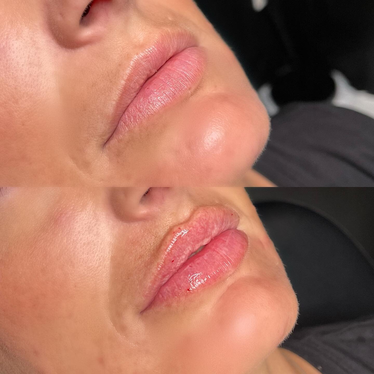 Perfect pout on the most perfect canvas 🫦

Love catching up with all the beautiful strong women I have the privilege of working with.
 

#lips #lipfillerbeforeandafter #plumplips #plump #nurseinjector #nurseinjectortraining #luxury #goodvibes #glowi