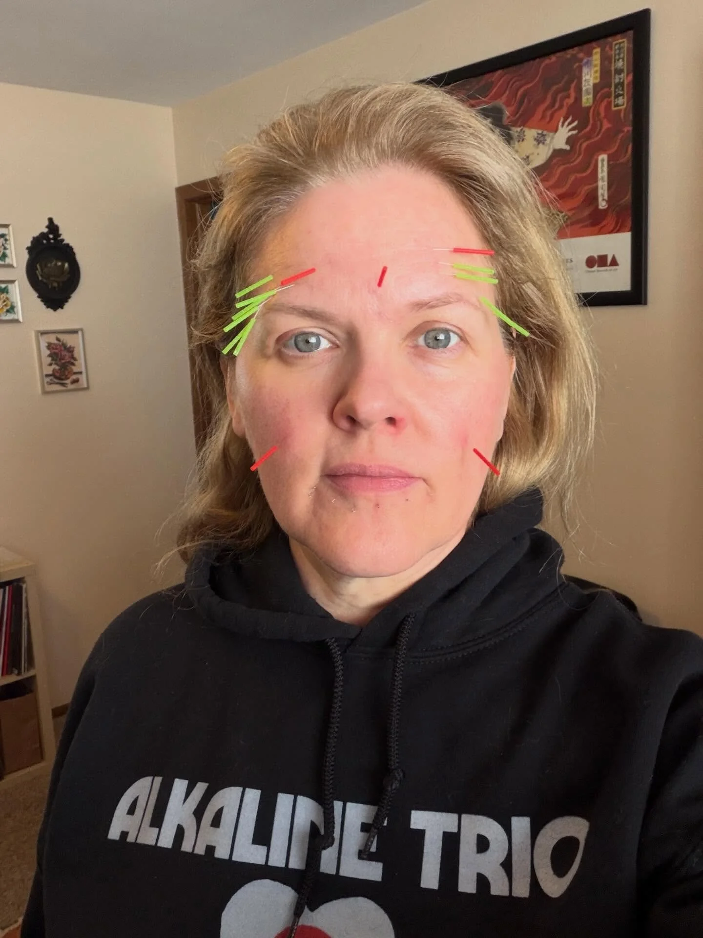 Snow day. Glow day. This is what cosmetic acupuncture looks like. I have some tiny pins called intradermals around my mouth, a few pins strategically placed in deeper lines, and pins in acupuncture points to reduce heat and inflammation caused by all