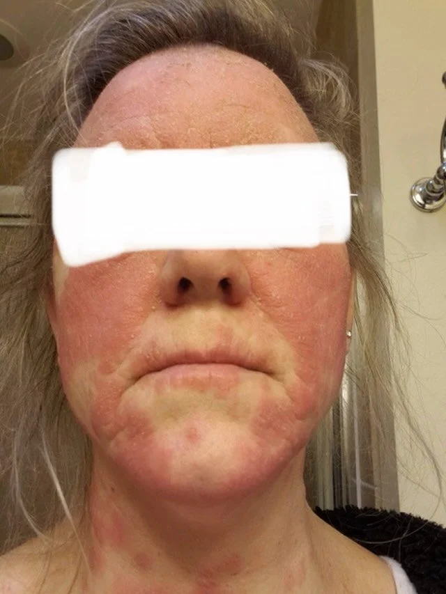 I really like helping people get allergy relief. Not enough people are aware of how magically acupuncture can relieve allergy symptoms. 

One of the first allergy cases I treated as a newly licensed acupuncturist was someone who'd had an allergic rea