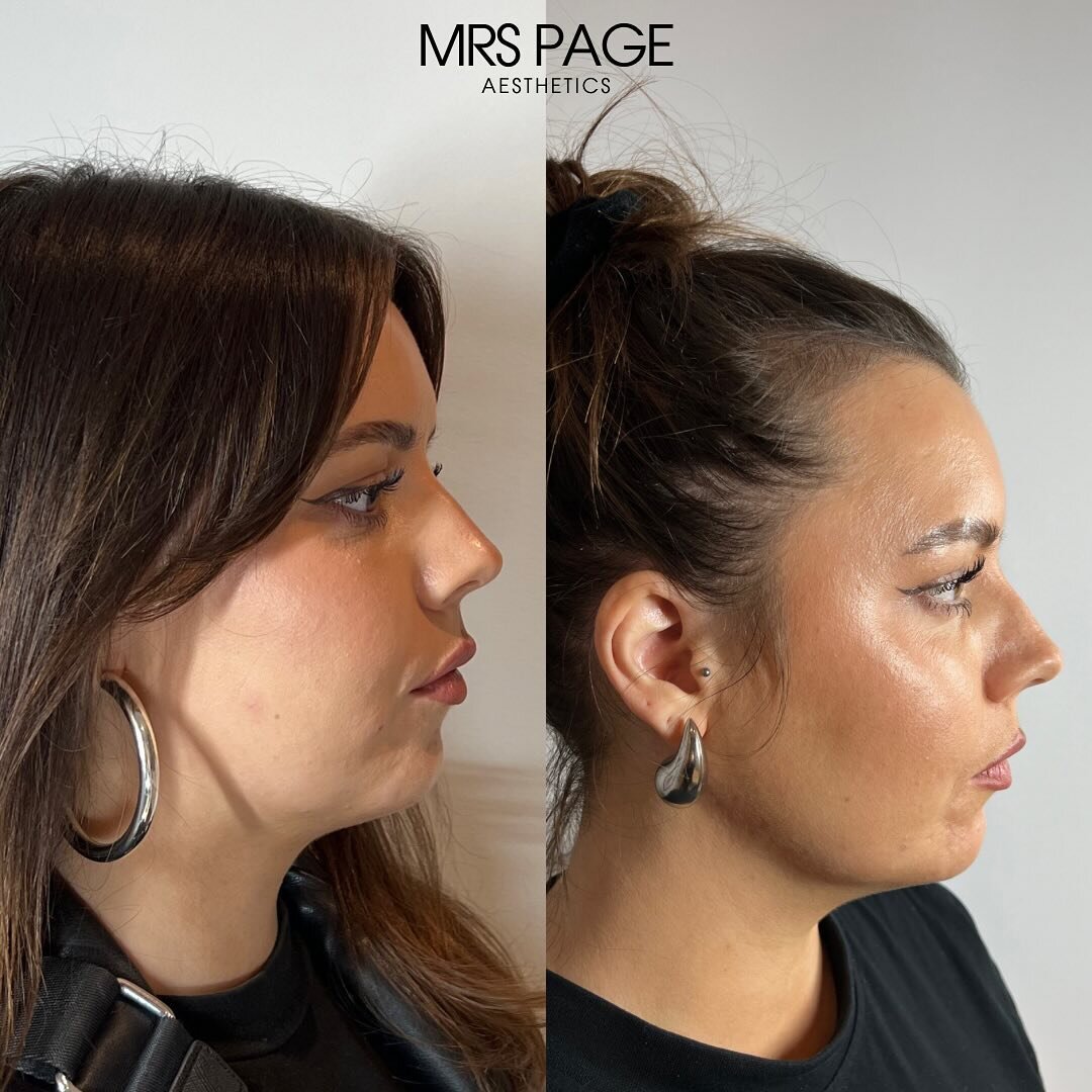 JAWLINE 🥹

Clients second round of lemon bottle on her chin and jawline! Just after 6 weeks since her first session! This product always seems to amaze me! 

For just &pound;100 per treatment it&rsquo;s a no brainer! 😜

Just 4 appointments left bef