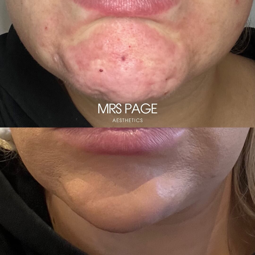PEBBLE CHIN &amp; DOWNWARD SMILE (using anti-wrinkle)

Look at this before and after&hellip; it&rsquo;s actually me 😂 My pebble chin is usually soo strong so I needed to stop the dimpling when I talk! Creating a smoother, more natural result!

💉 Tr