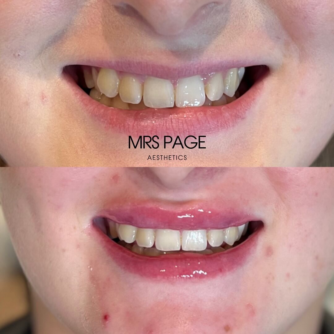 GOSH it&rsquo;s been a while since I last posted! Working back to back on the build up to Christmas has been liberating but exhausting! 🥹

This amazing before and after is from a client having a lip flip and then dermal filler to focus on building b