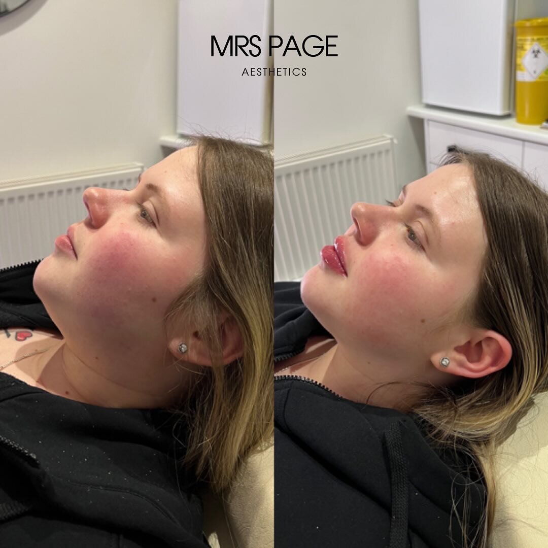 6 days after lemon bottle AND a slight lip filler enhancement for the most beautiful soul 🥹

0.5ml dermal filler used to enhance her already beautiful lips and lemon bottle on chin which is only 6 days difference!

💉 Treatment - 0.5ml lip filler an