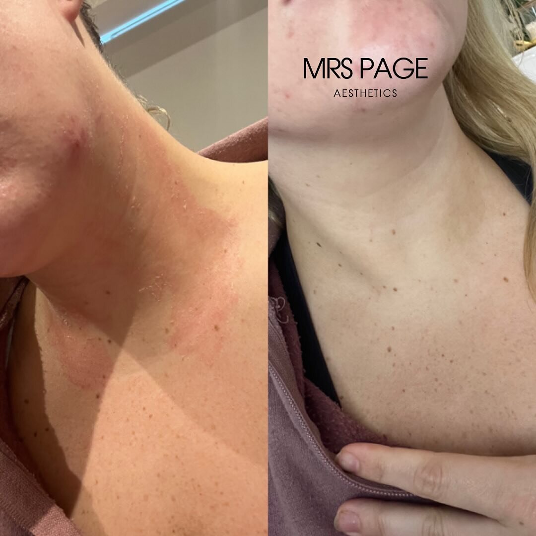 My Eczema Journey - this is 6 days difference and 4 sessions of the LED Light Therapy using blue and NIR light combined!

What does LED Light Therapy do?
RED LIGHT - 
- increases collagen production
- restores cell function
- provides essential energ