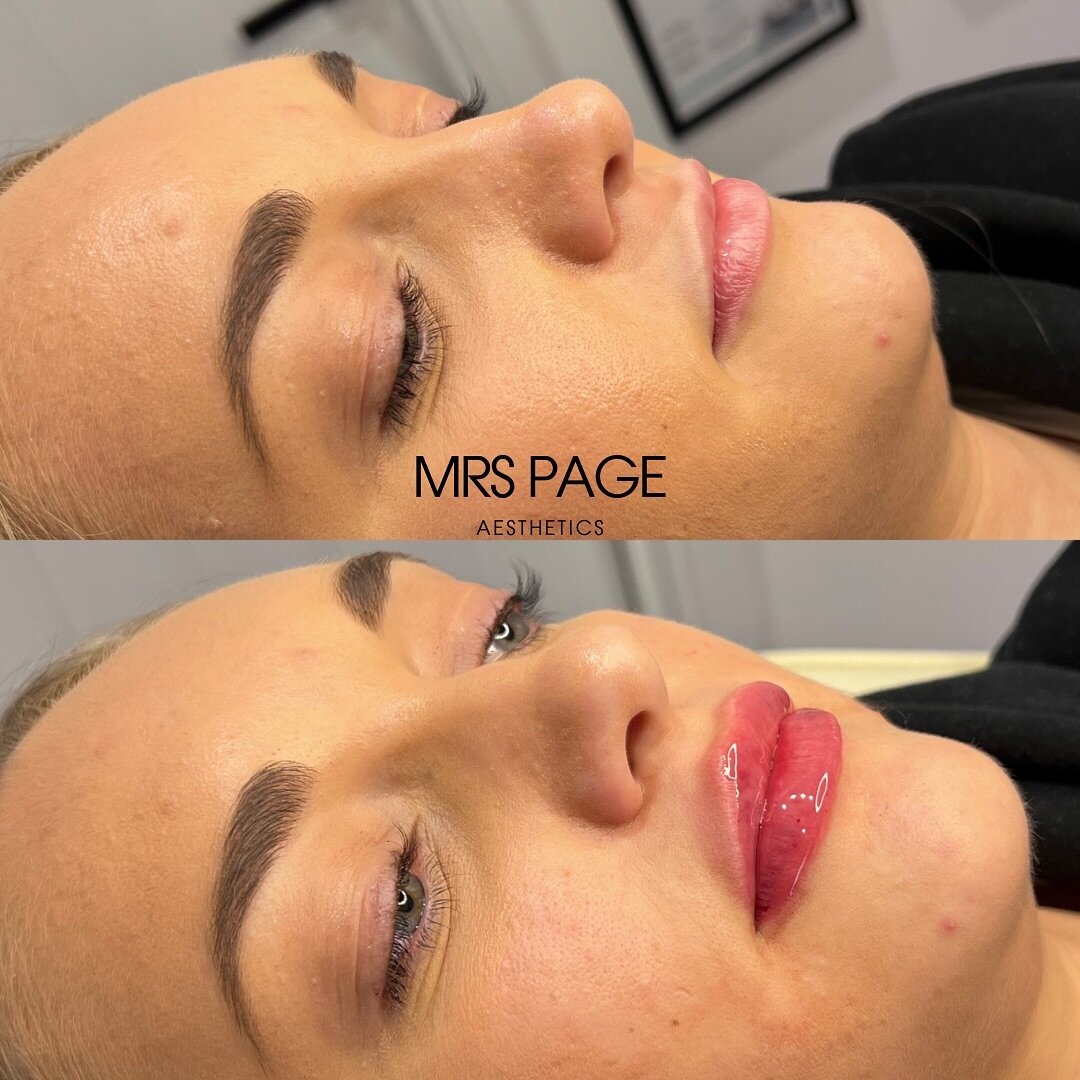 I AM SORRY&hellip; I have been MIA on my main grid - this social media life is intense&hellip; I have thousands of before and after photos to show you all&hellip; just bear with me! 😉

This is my clients third time getting lip filler with me and sho