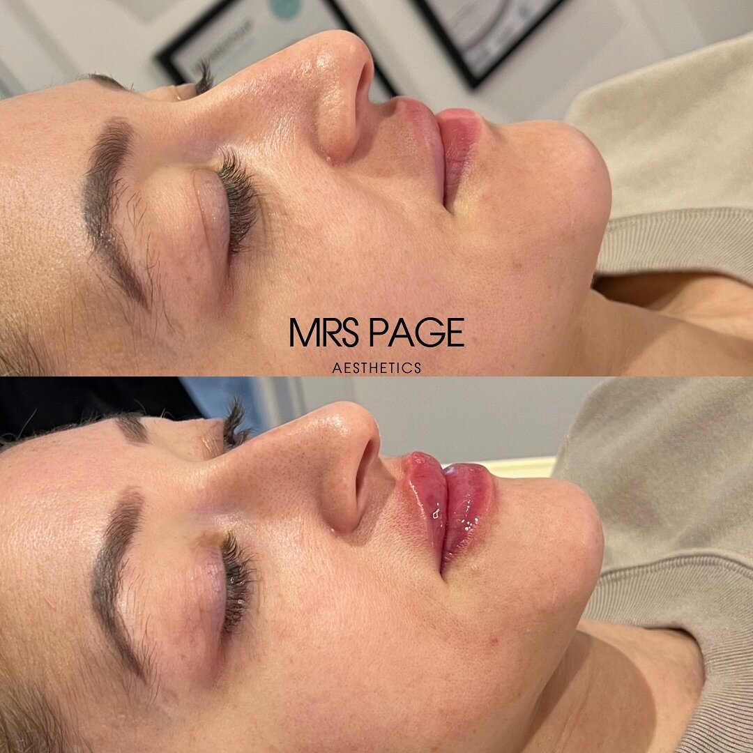 Happy Sunday! 

This is your sign to get booked in for lip filler 💋 Natural, crispy vermillion border and plump! What&rsquo;s not to love!? 

💉 Treatment - 0.5ml Lip Filler
💰 Price - &pound;135
🖤 Book now via Booking Link, WhatsApp, Phone, Email 