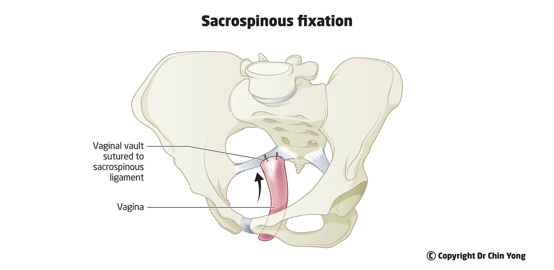 Vaginal sacrospinous ligament fixation for vaginal prolapse at Epworth Freemasons, East Melbourne