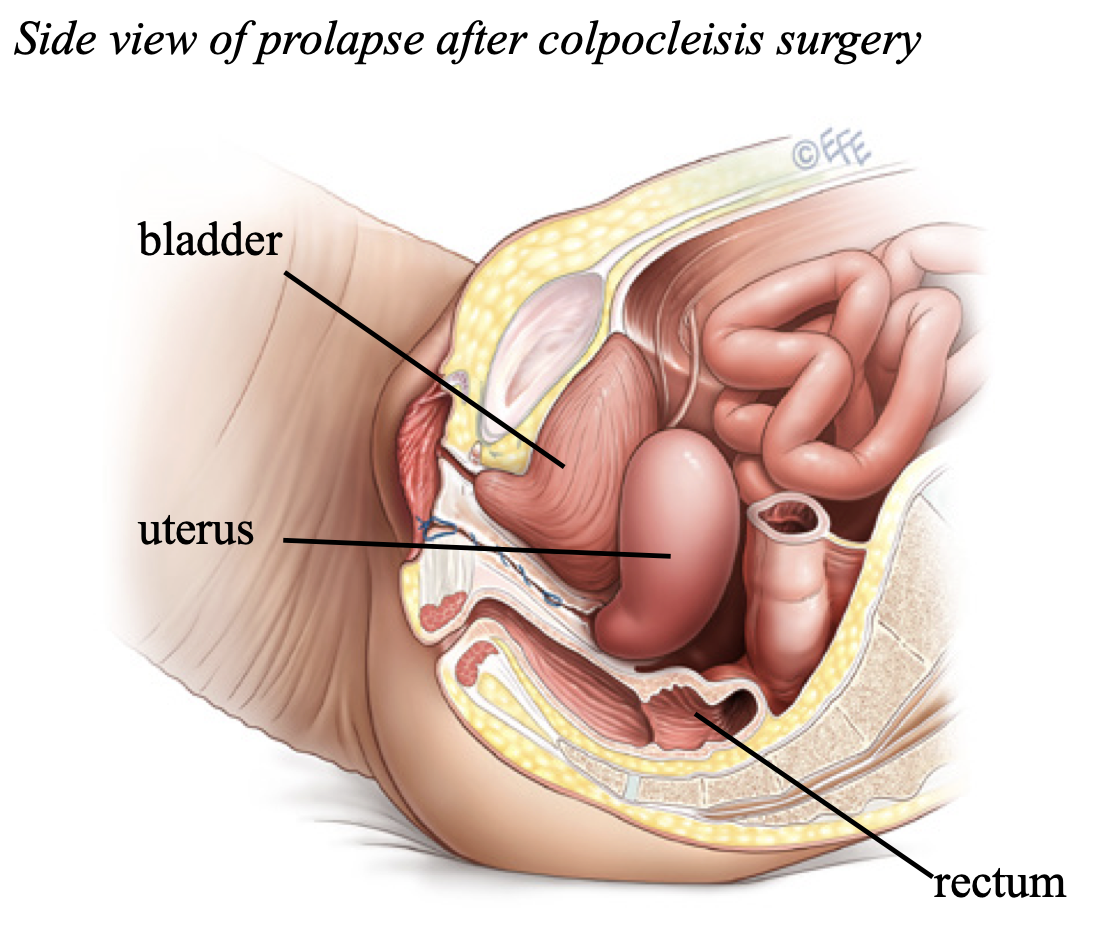 Colpocleisis is offered as minimally invasive surgery option at Epworth Freemasons, East Melbourne