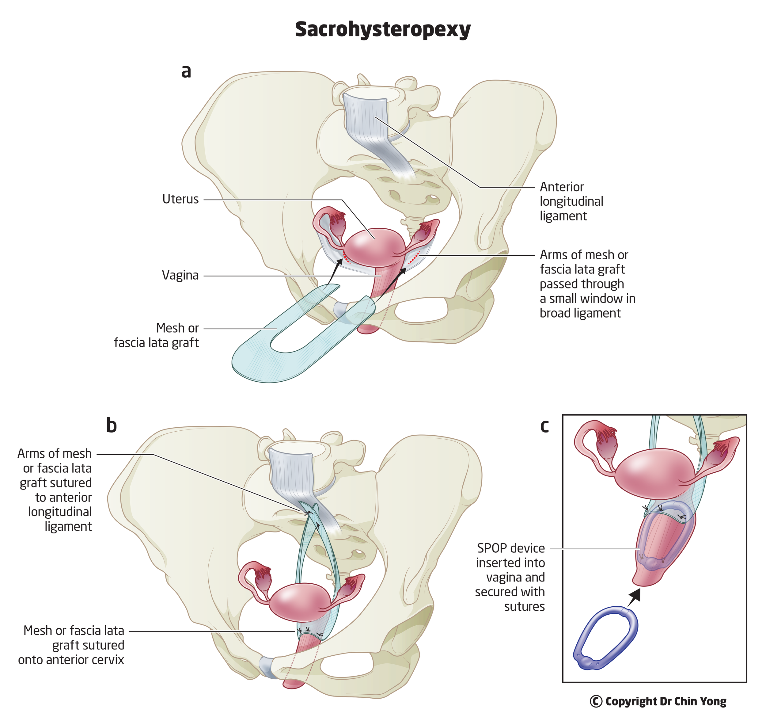 Dr Chin Yong performs laparoscopic or robotic-assisted mesh sacrohysteropexy to treat uterine prolapse at Epworth Freemasons, East Melbourne
