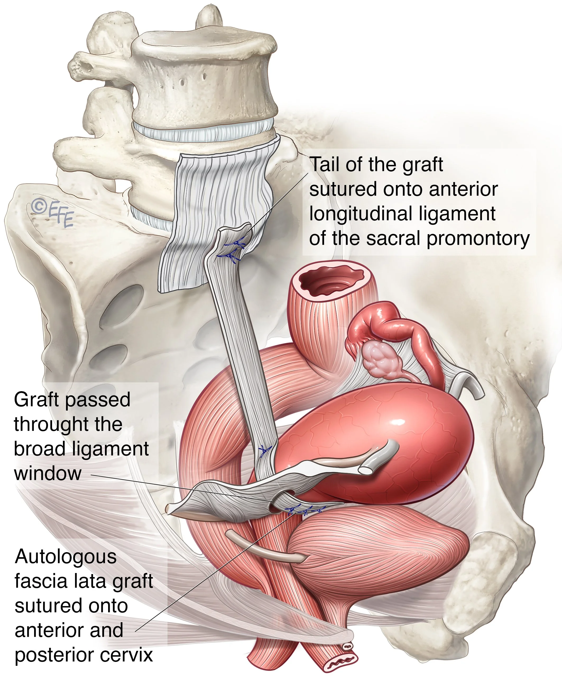 Dr Chin Yong performs laparoscopic or robotic-assisted fascia lata sacrohysteropexy to treat uterine prolapse at Epworth Freemasons, East Melbourne