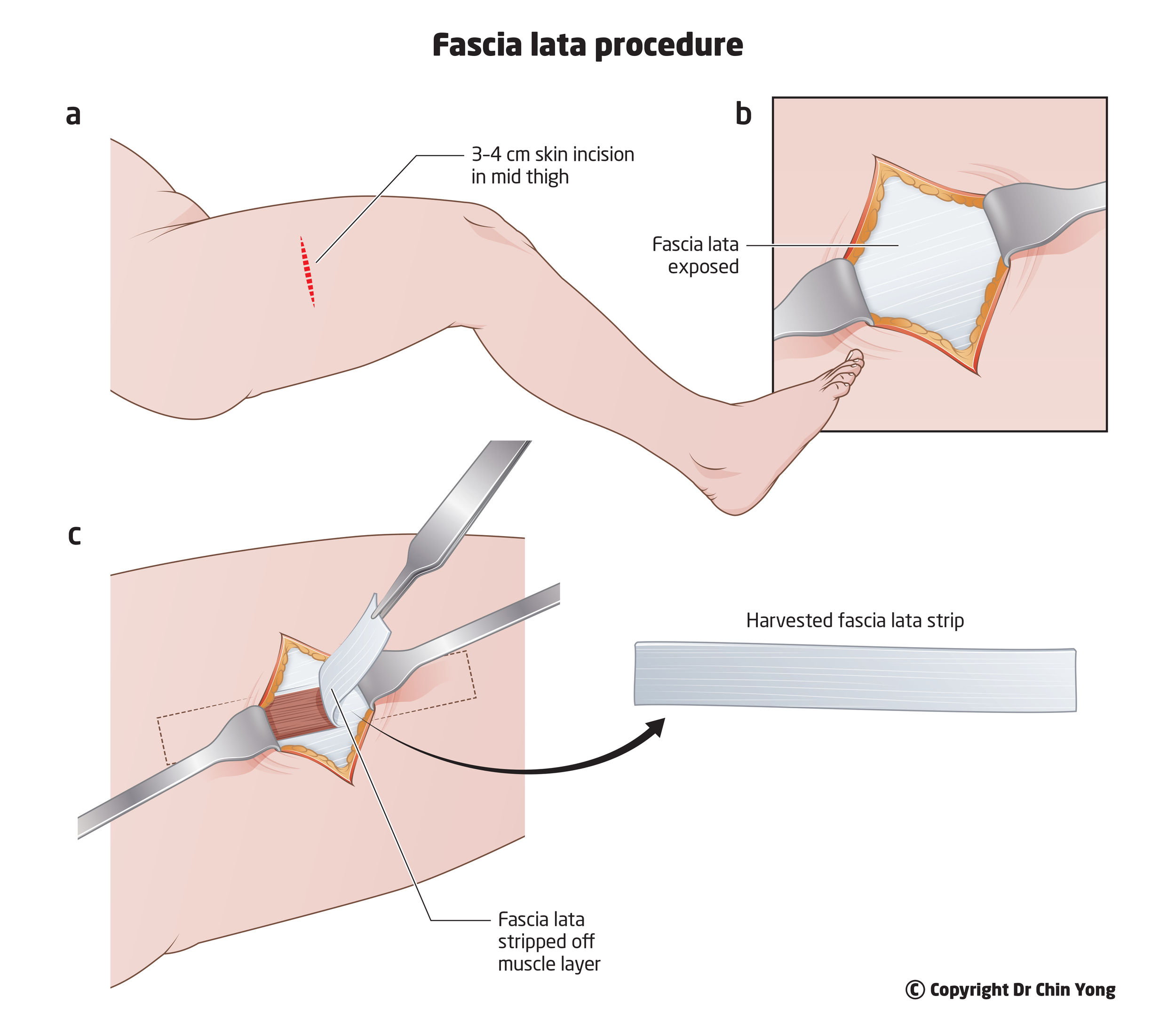 Dr Chin Yong fascia lata procedure at Epworth Freemasons, East Melbourne