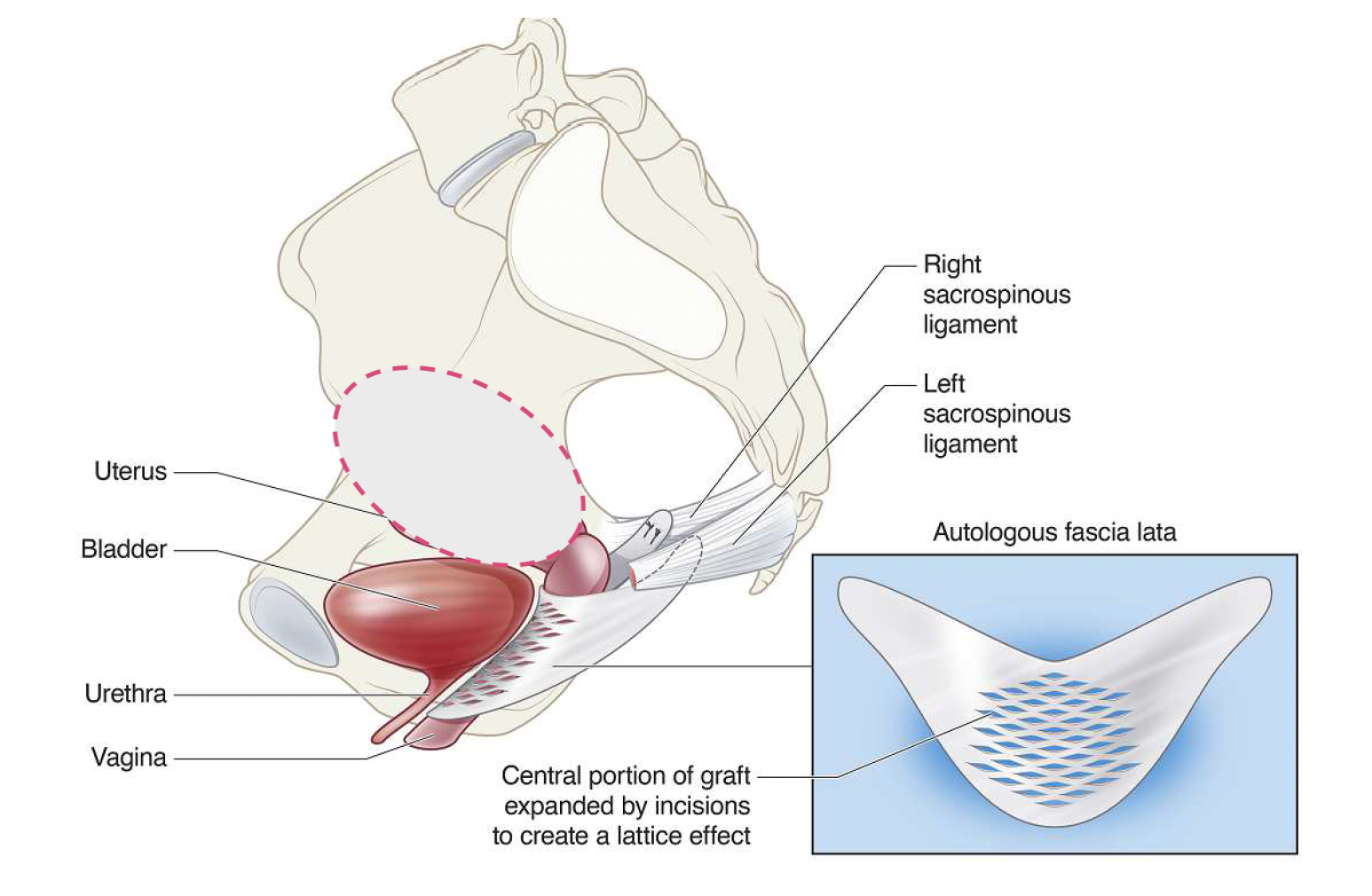 Dr Chin Yong anterior vagina wall repair reinforced using autologous fascia lata at Epworth Freemasons, East Melbourne