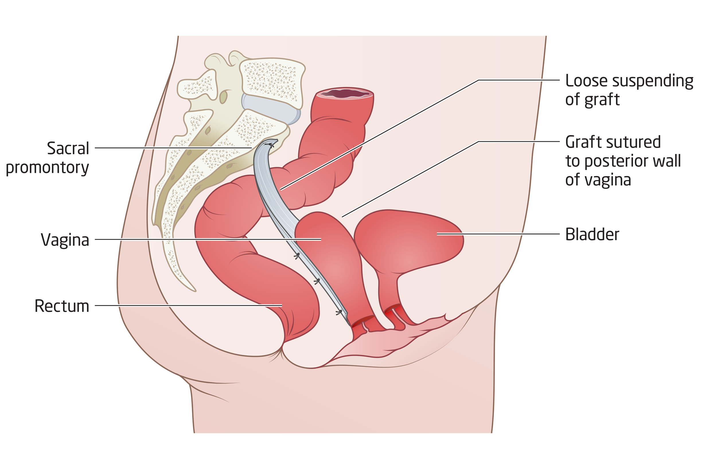 Dr Chin Yong performs laparoscopic or robotic-assisted fascia lata sacrocolpopexy to treat vault prolapse at Epworth Freemasons, East Melbourne