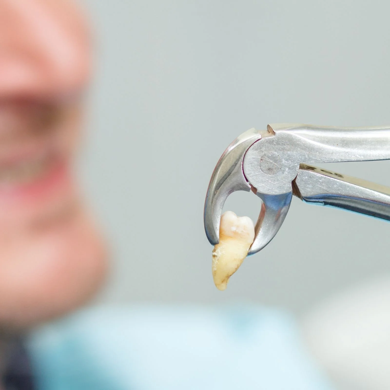 Tooth Extractions in Merchiston Edinburgh at Ardmillan Dental Practice