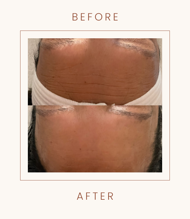 Before and after comparison of forehead lines treatment.