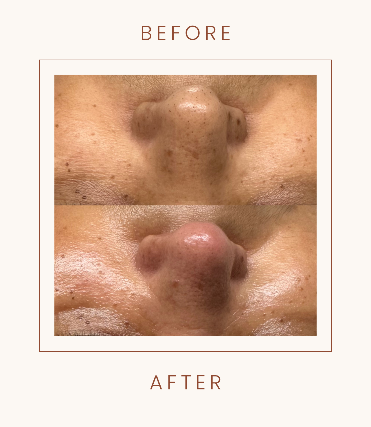 Before and after skincare treatment on nose, showing improved skin texture and reduced blemishes.