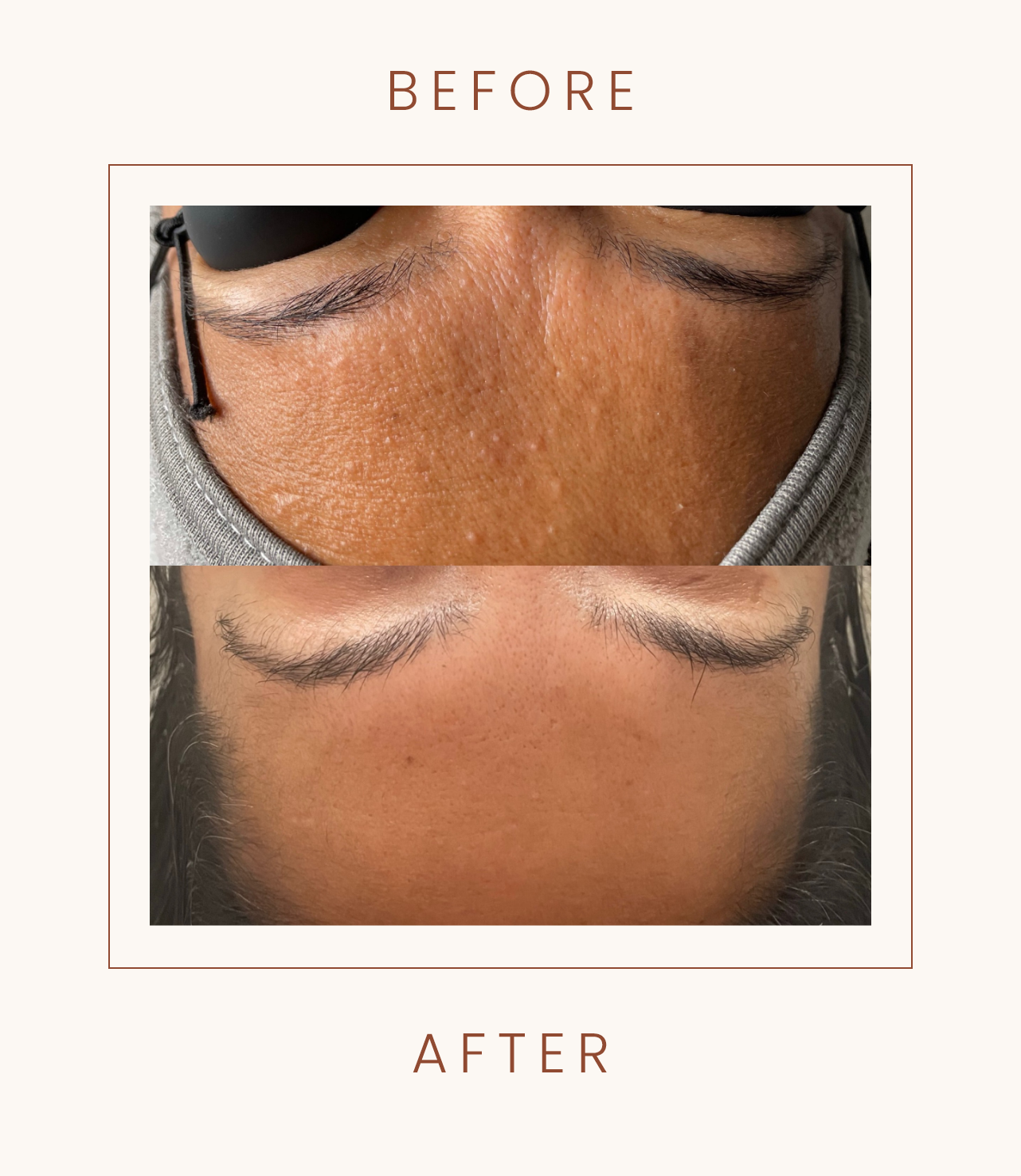 Before and after forehead treatment comparison
