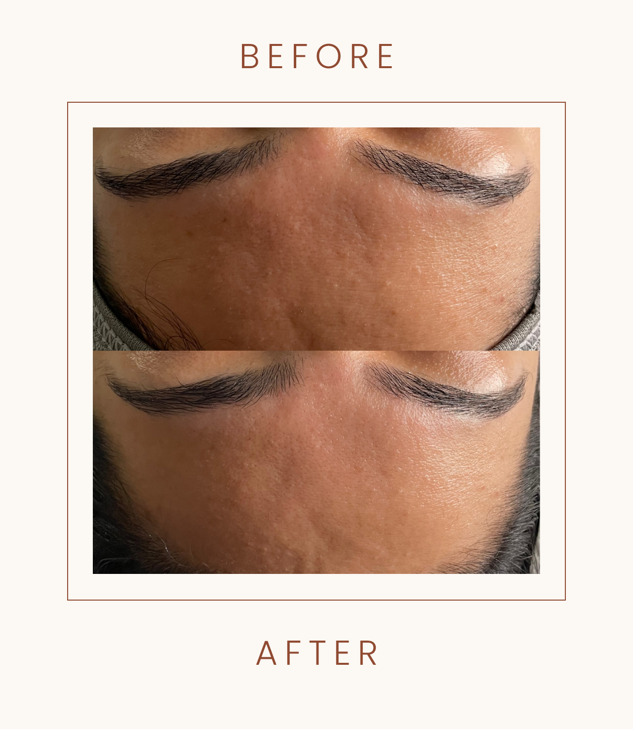 Comparison of a forehead before and after a treatment, showing smoother skin texture in the 'after' image.