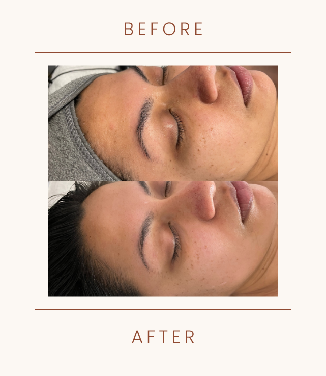 Before and after comparison of facial skin treatment, showing improvements in skin texture and clarity.