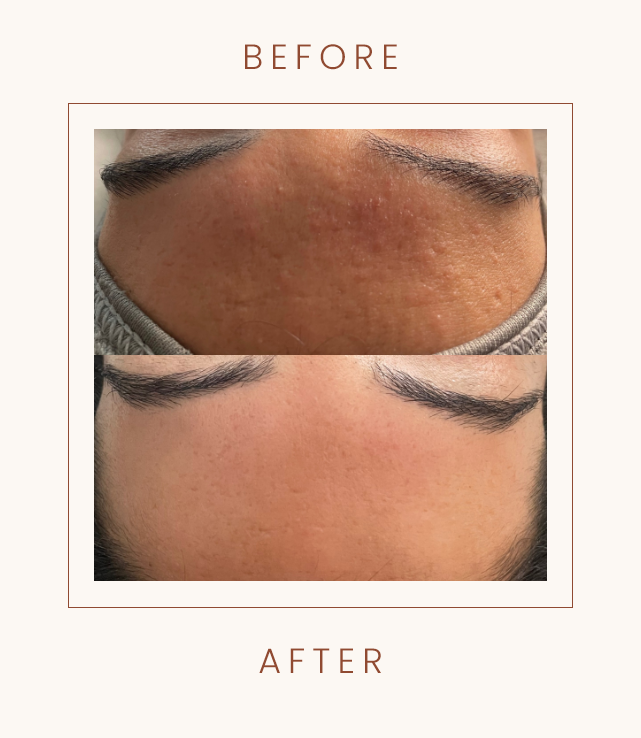 Before and after images of a person's forehead showing improved skin texture and reduced blemishes.