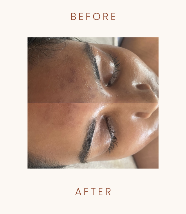 "Before and after comparison of facial skin treatment showing reduced blemishes and smoother skin texture."