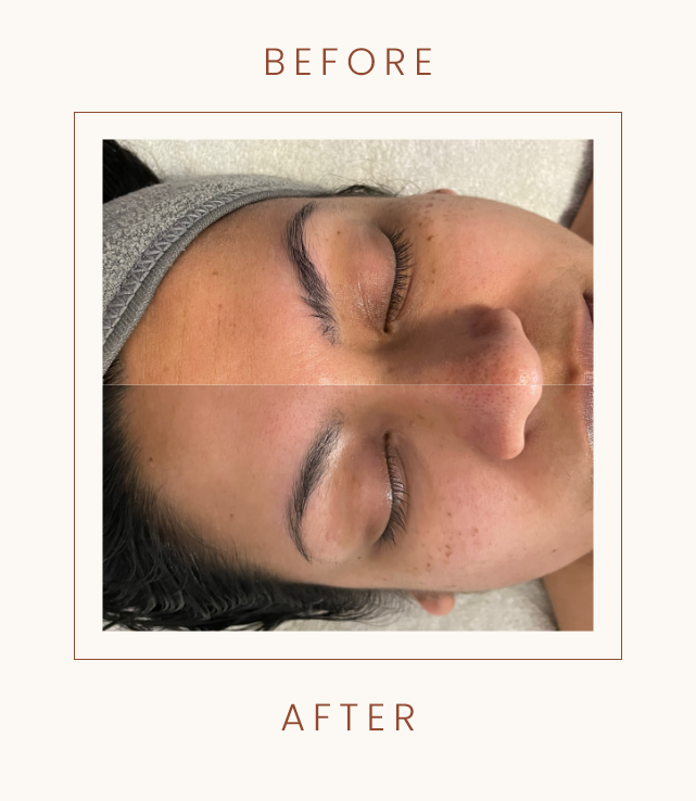 Split image showing a person's face before and after a skincare treatment, highlighting improvements in skin texture and clarity.