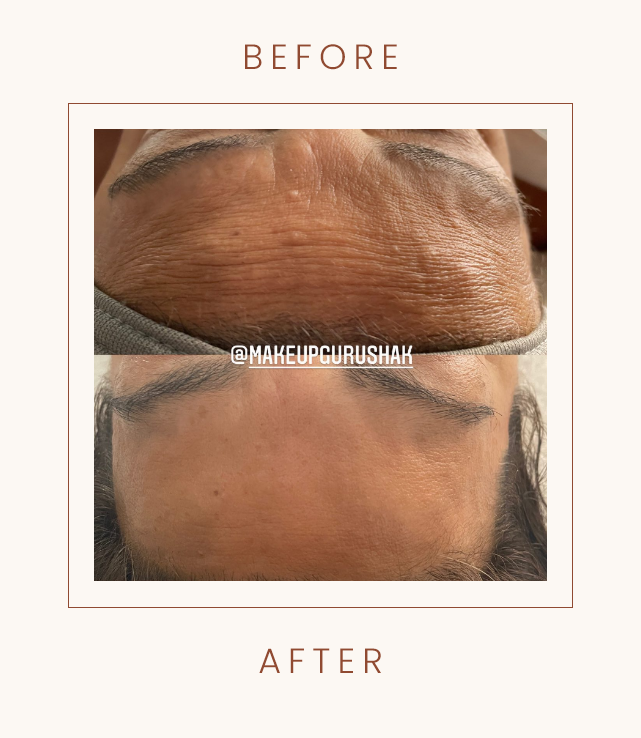 Before and after images of a person's forehead, showing a reduction in wrinkles or skin texture improvement. Includes a watermark "@makeupgurushak."