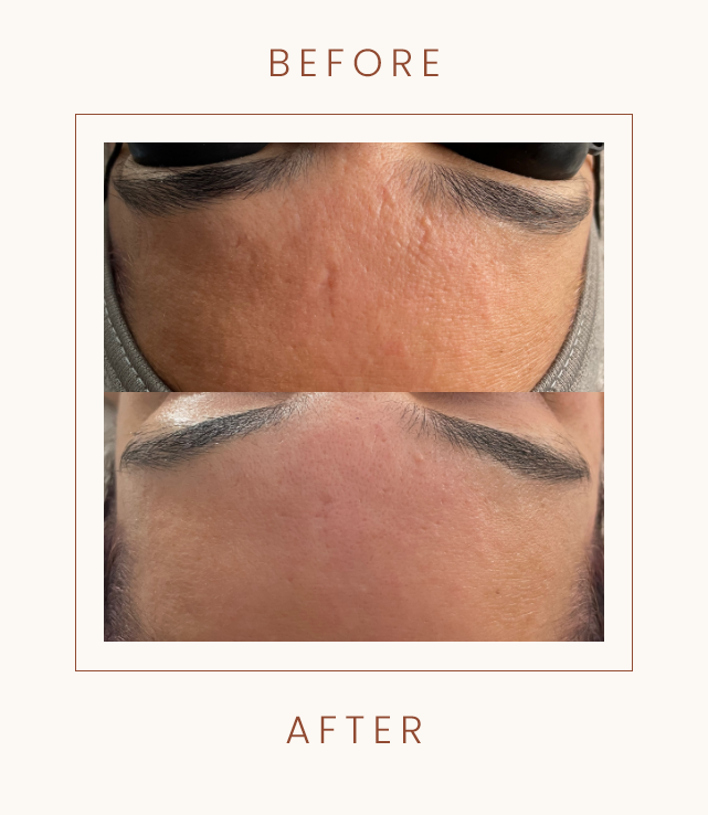 Before and after comparison of a person's forehead showing skin improvement, with reduced texture and smoother appearance.
