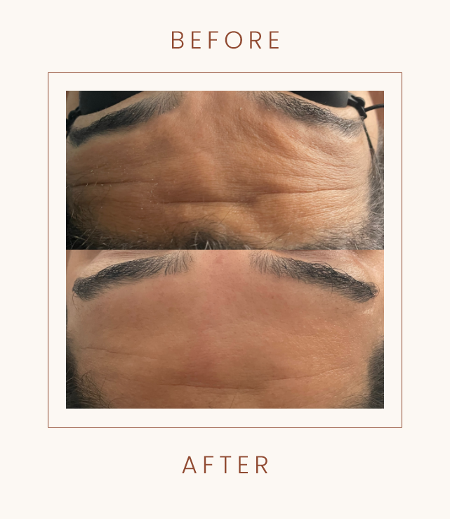 Before and after images of a forehead showing reduced wrinkles.