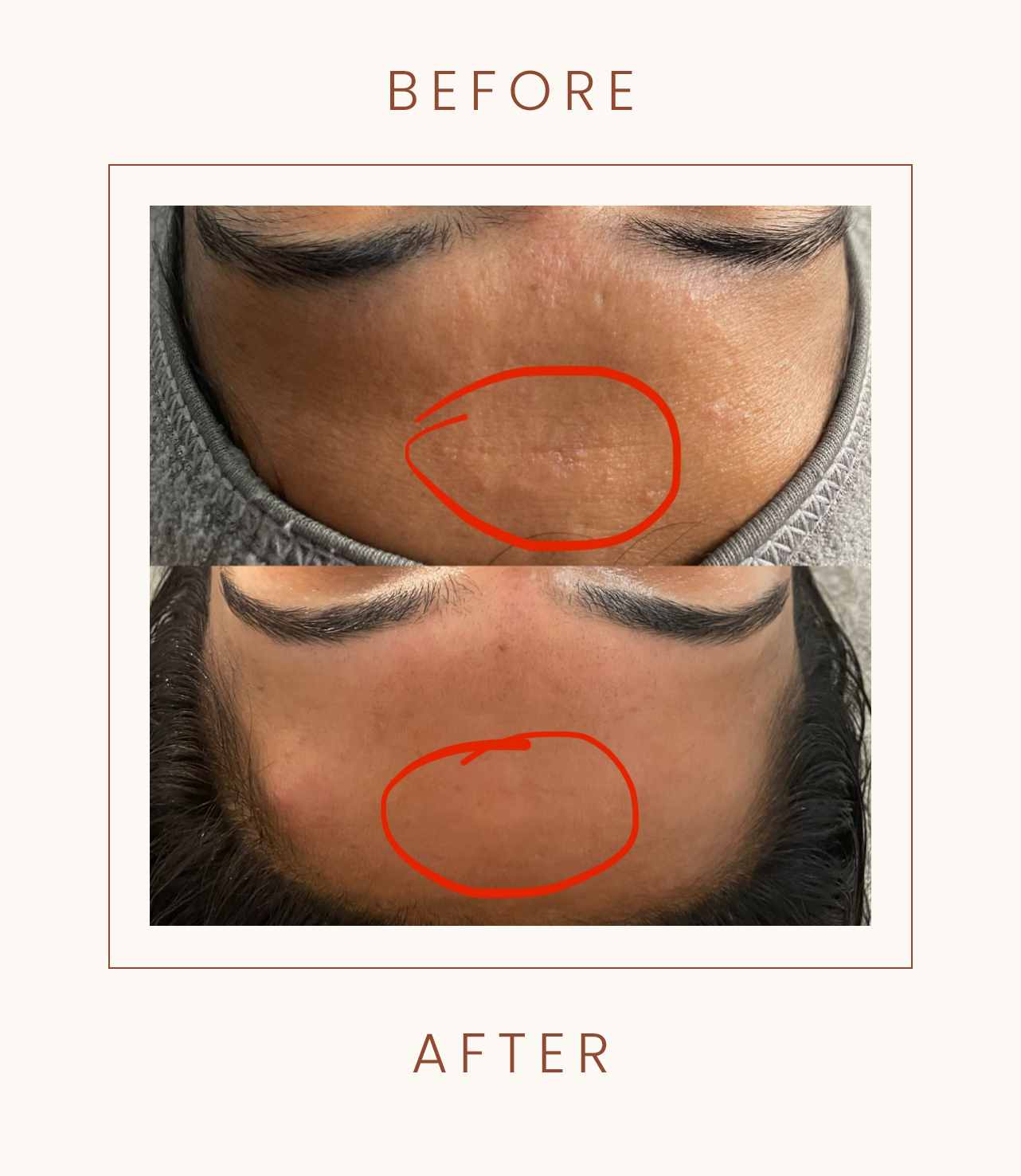 Before and after images of a person's forehead with a red circle highlighting a reduction in fine lines or wrinkles.